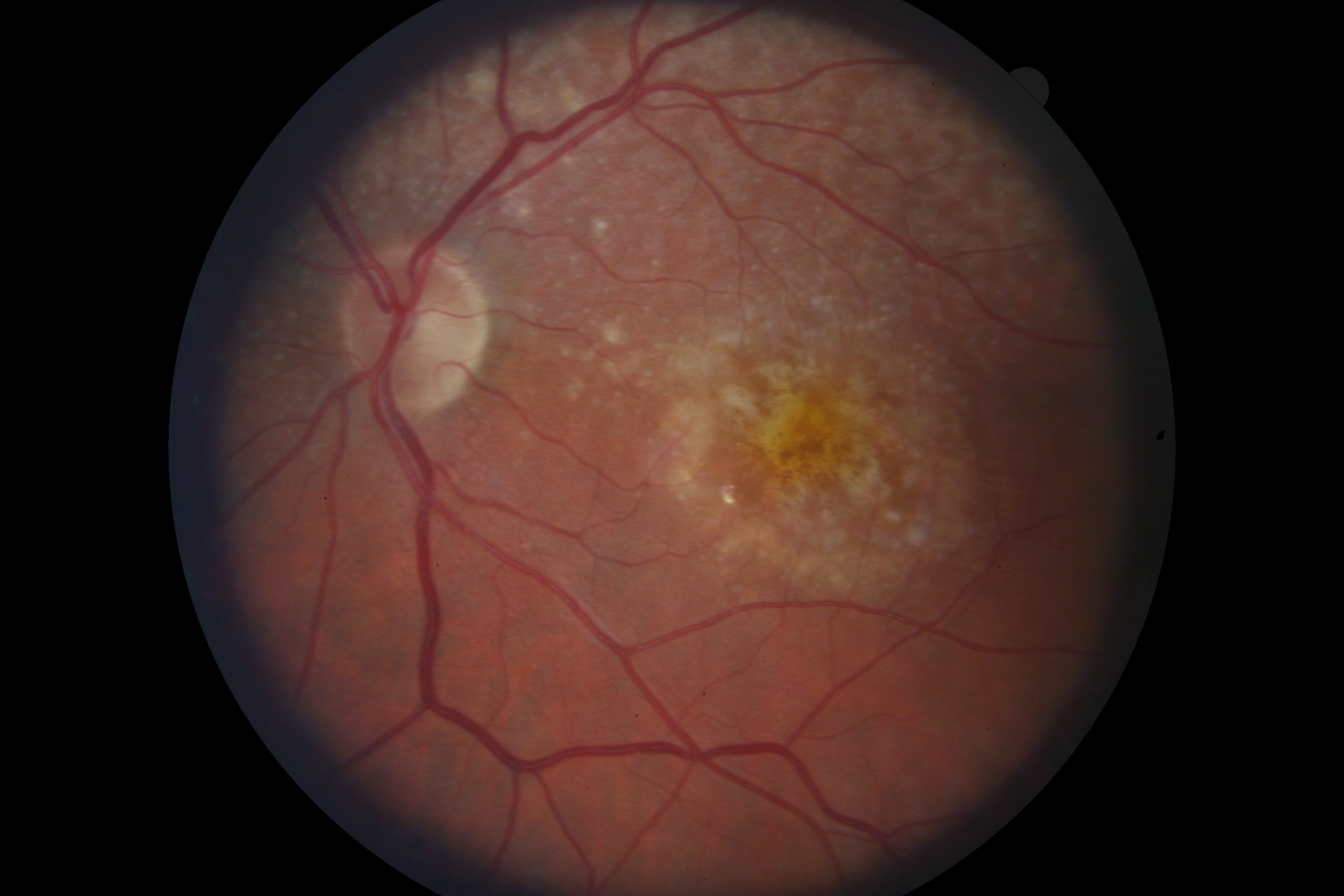 retinal scan of dry macular degeneration
